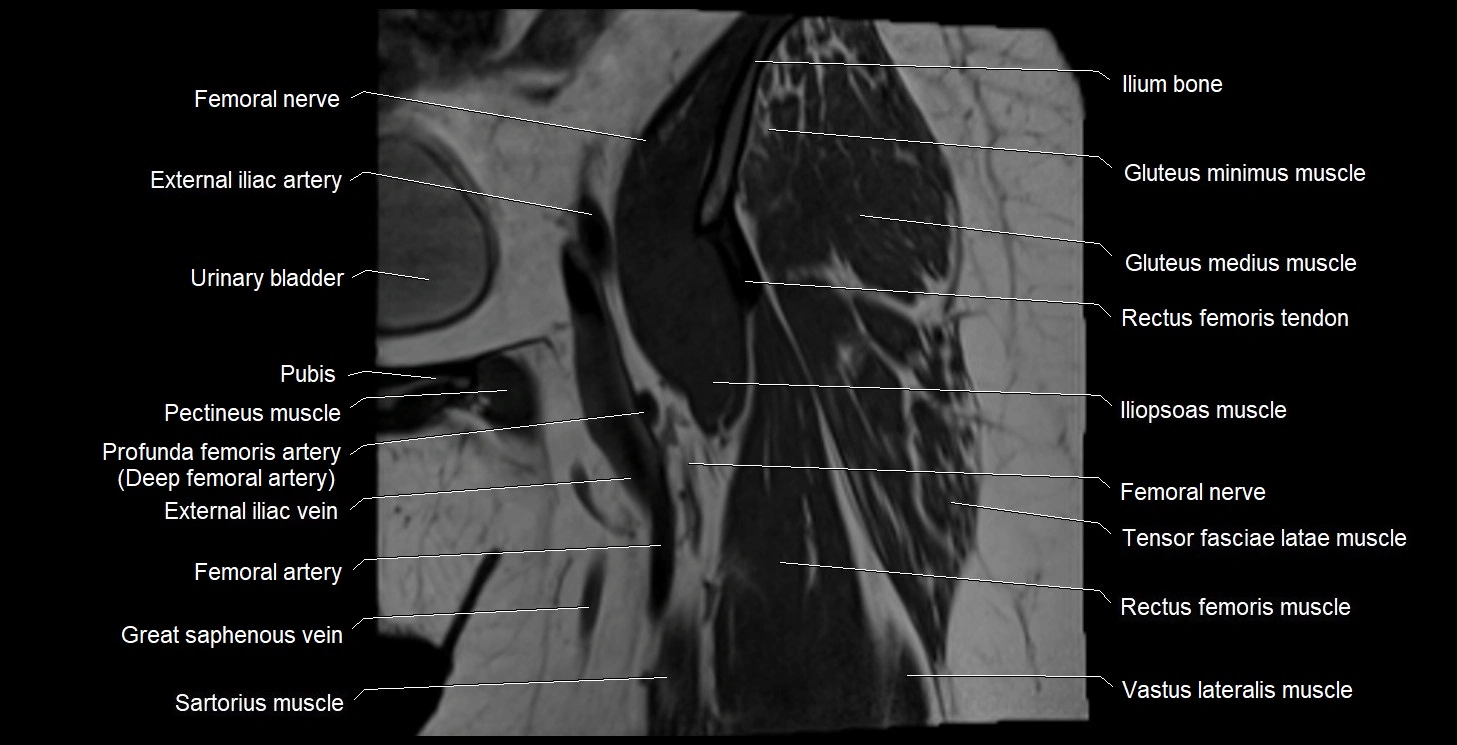 MRI Hip 3T coronal cross sectional anatomy image 12.webp